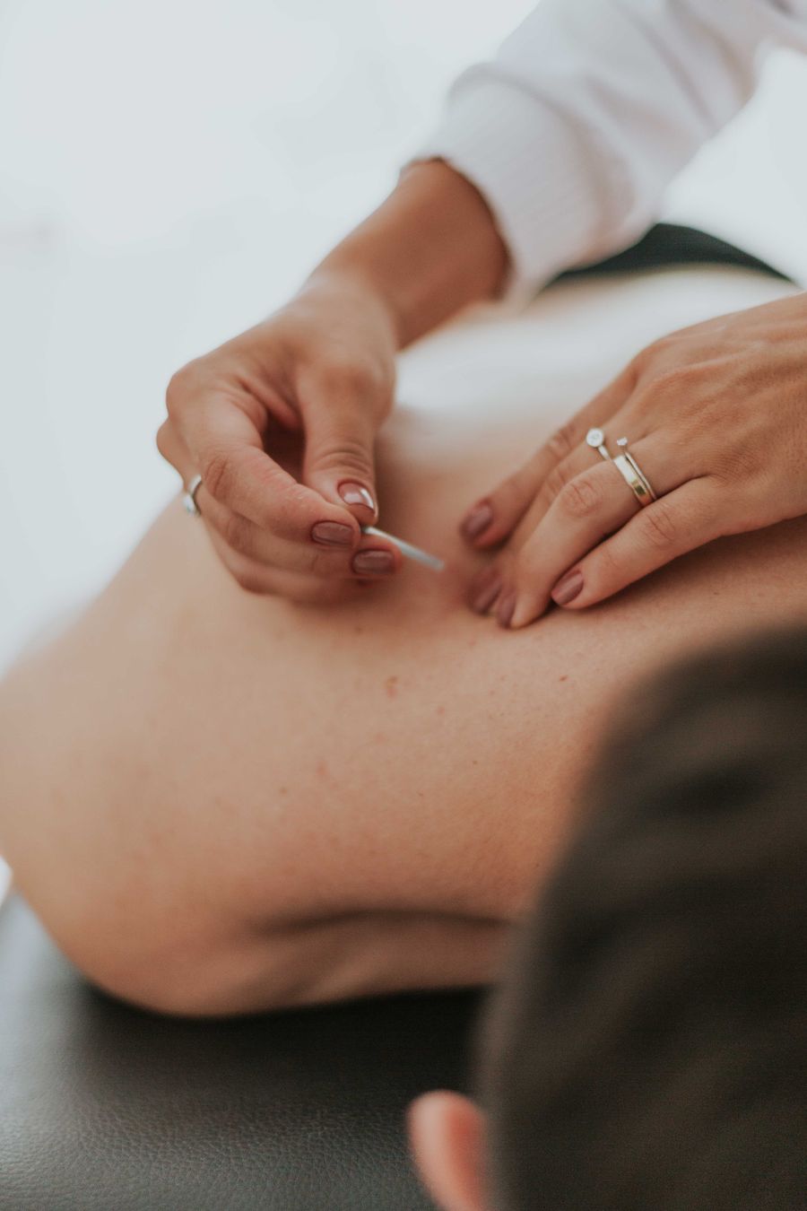 Acupuncture needles placed along a patient's back in a calm treatment room