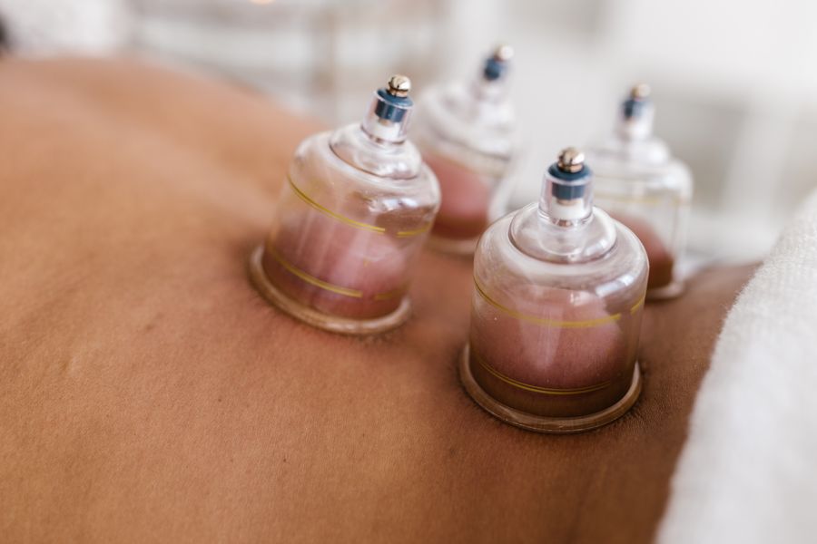 Glass cups applied to a patient's back during cupping therapy
